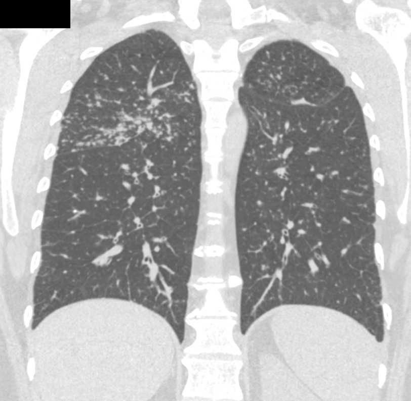 Miliary TB with Tree in Bud Appearance - Chest Case Studies - CTisus CT Scanning