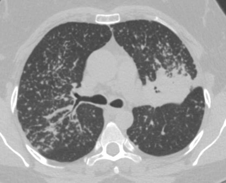 Miliary TB with Tree in Bud Appearance - Chest Case Studies - CTisus CT