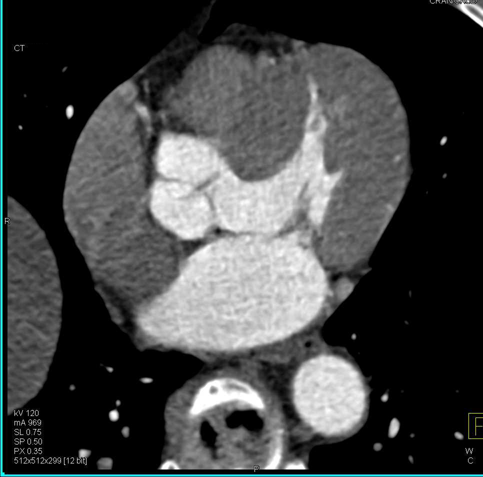 Hypertrophy Left Ventricle with Thickened Wall - Chest Case Studies