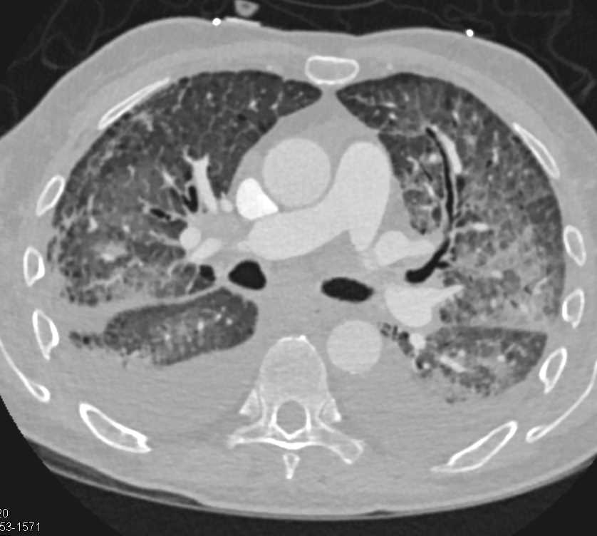 Pulmonary Edema in Patient with Interstitial Lung Disease - Chest Case