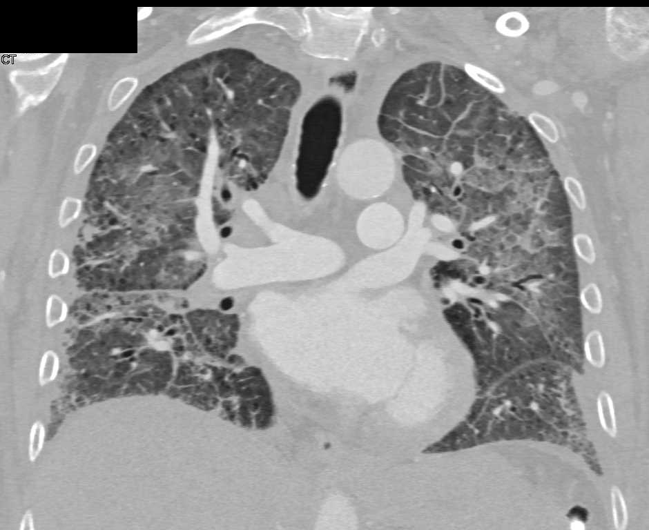 Pulmonary Edema in Patient with Interstitial Lung Disease - Chest Case