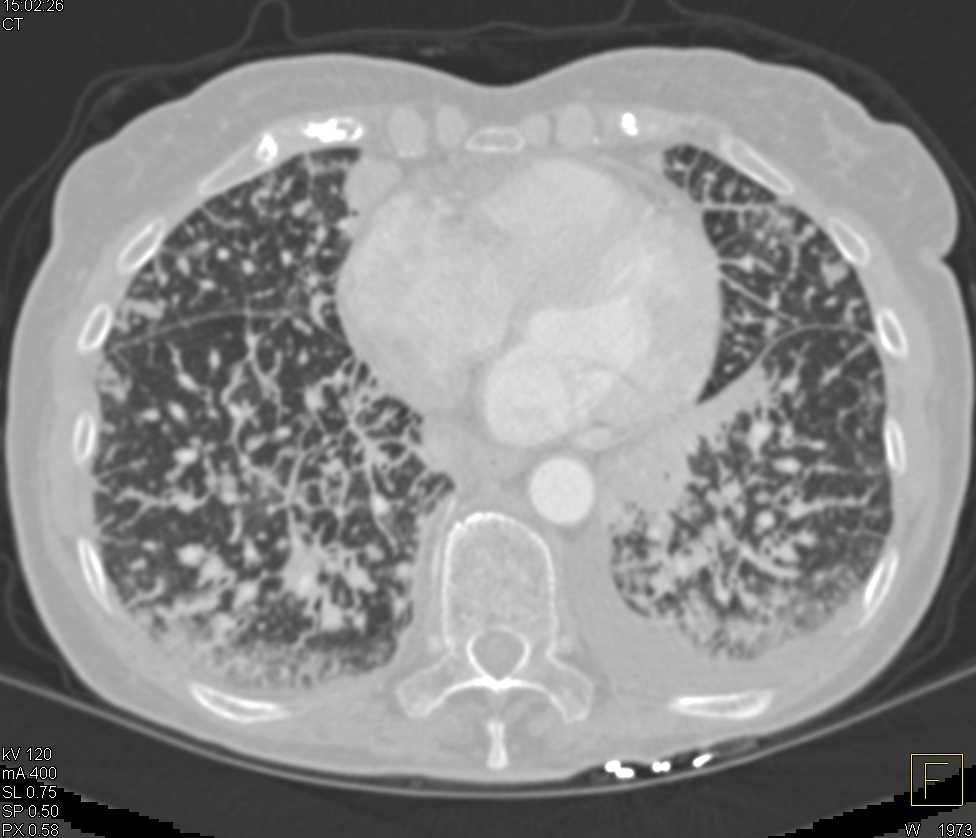 Lymphangitic Spread Due To Lung Cancer Chest Case Studies Ctisus Ct