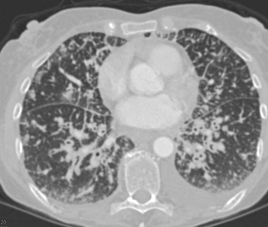 Lymphangitic Spread due to Lung Cancer - Chest Case Studies - CTisus CT
