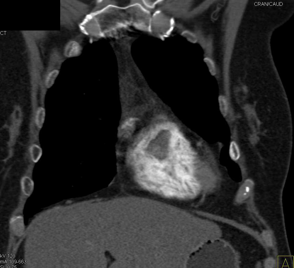 Cardiac Lymphoma With Multiple Satellite Lesions Chest Case Studies
