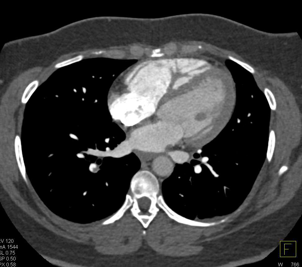 Pulmonary Embolism Right Lower Lobe - Chest Case Studies - CTisus CT