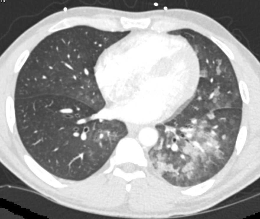 Pulmonary Hemorrhage Best Seen in the Left Lung - Chest Case Studies