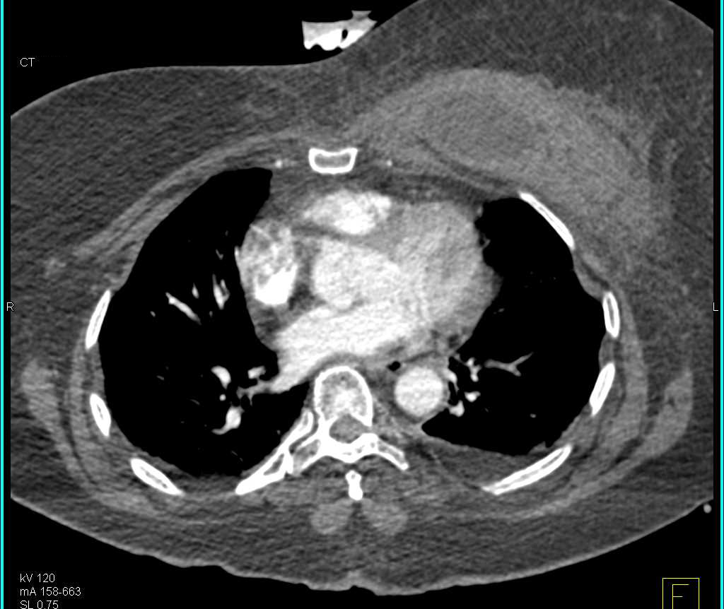 Hematoma with Fluid Fluid Level in the Left Breast - Chest Case Studies
