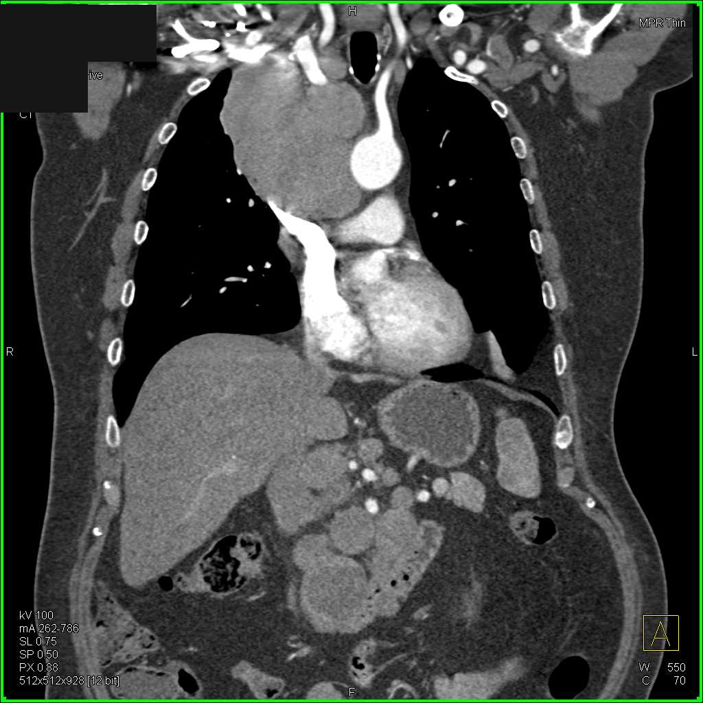 Lymphoma with Bulky Nodes in the Mediastinum and Abdomen - CTisus CT Scan
