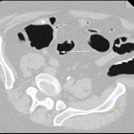 colon polyp small virtual ct ctisus 9mm 8mm studies case significant cecum stool residual