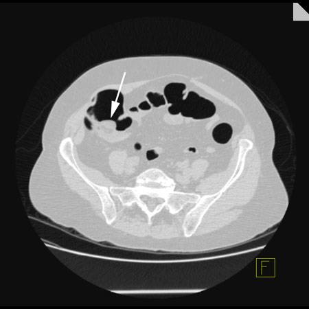 virtual colon: Lipomatous hypertrophy ileocecal valve. - CTisus CT Scan