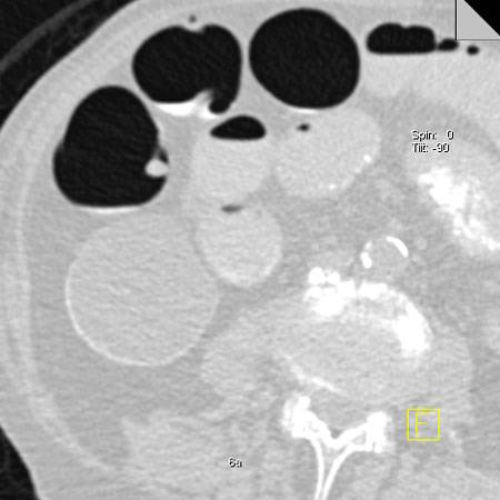 virtual colon: Small 8mm polyp ascending colon. - CTisus CT Scan