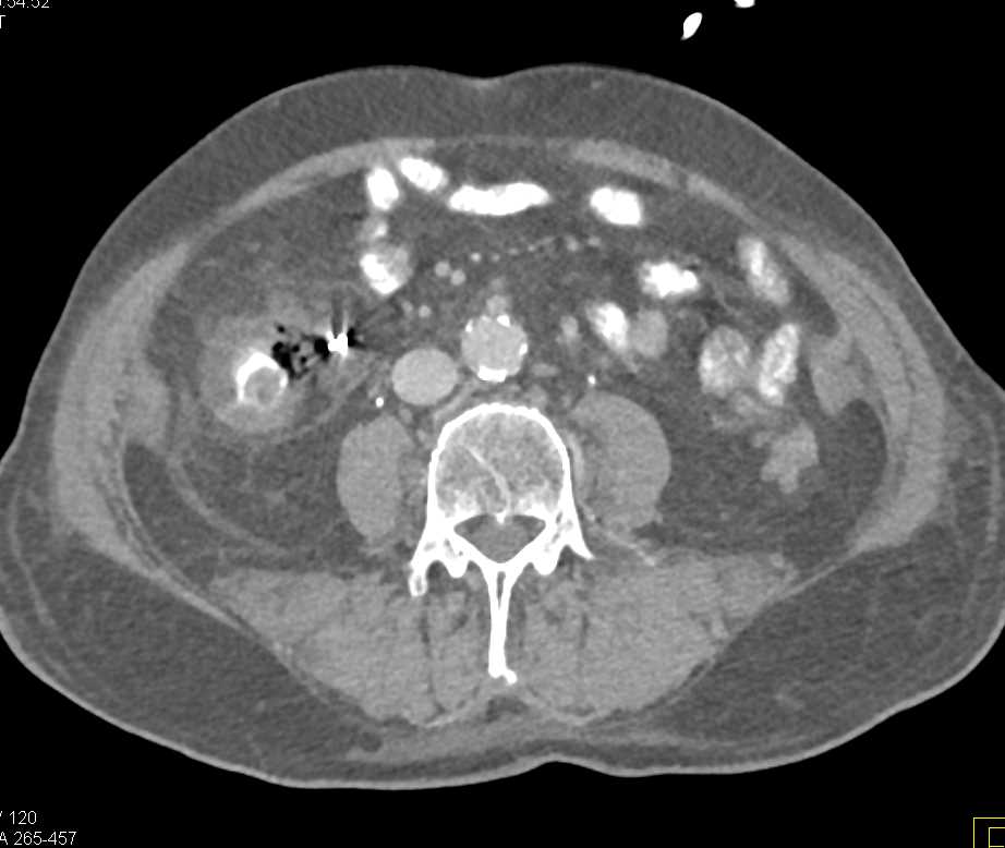 Right Sided Diverticulitis Colon Case Studies Ctisus Ct Scanning