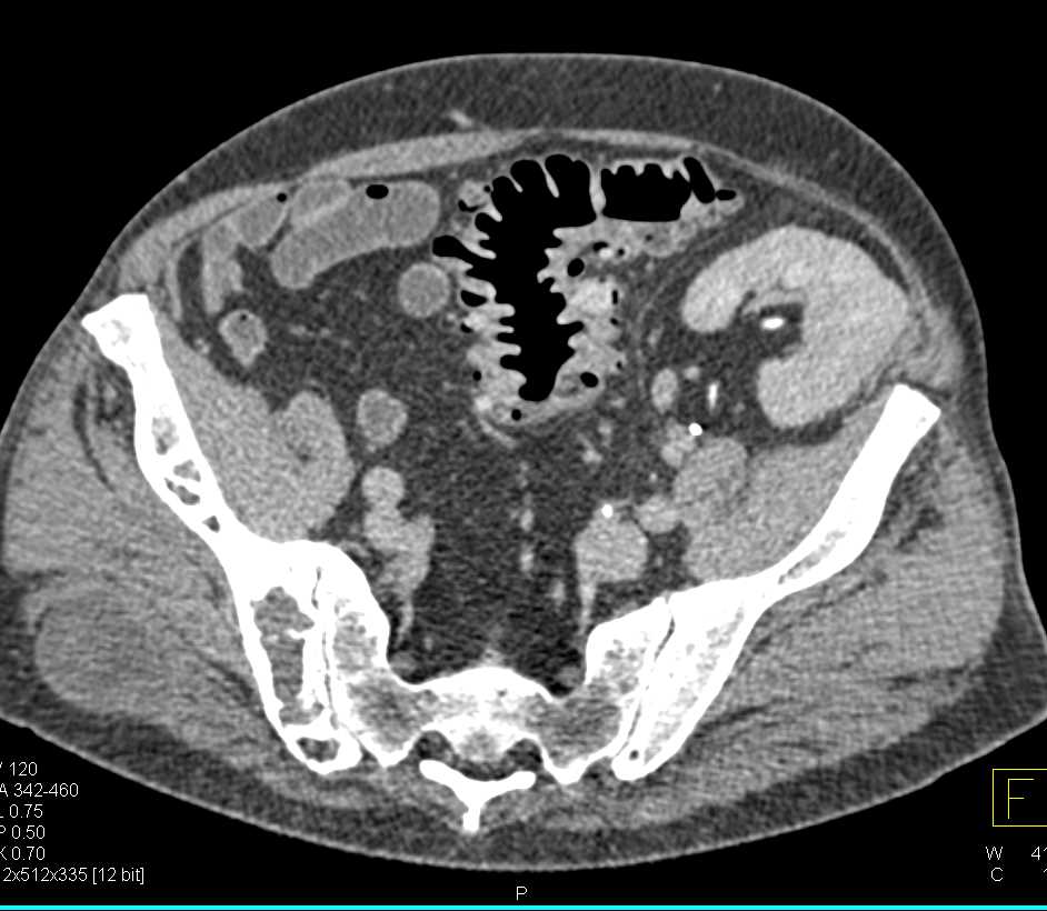 Can A Ct Scan Detect Bowel Cancer