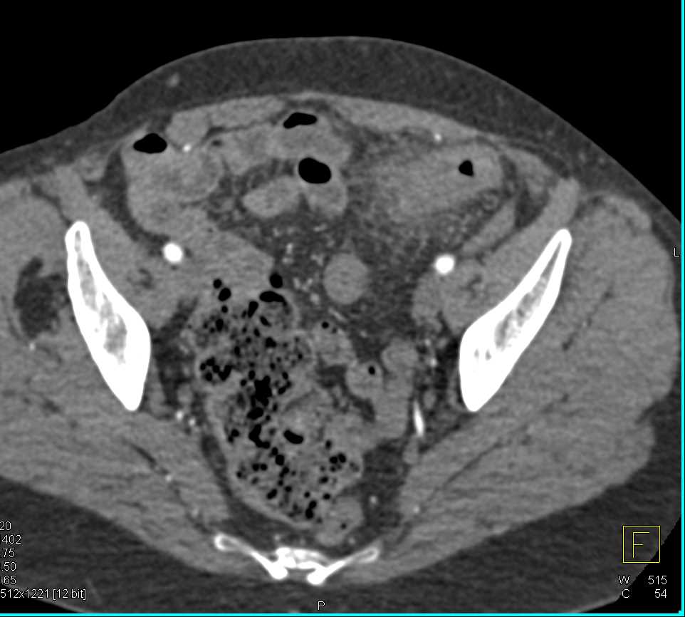 Diverticulitis Descending/Sigmoid Colon Junction - CTisus CT Scan
