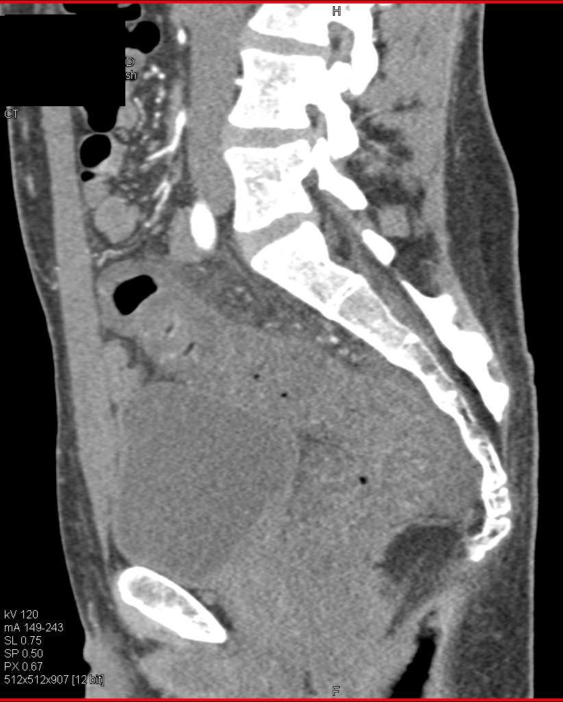 Infiltrating Rectal Cancer with Local Spread - CTisus CT Scan