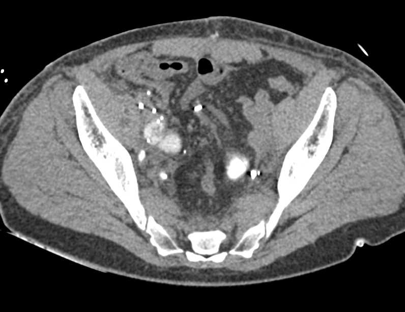 rectal-contrast-colon-without-extravasation-colon-case-studies