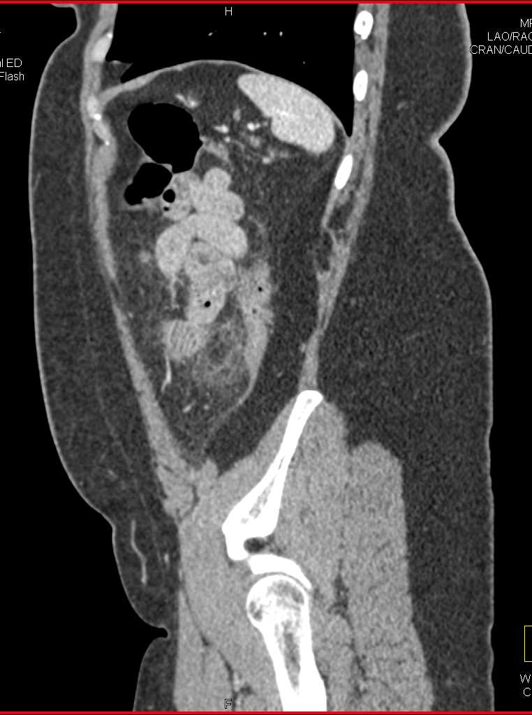 Diverticulitis With Abscess Colon Case Studies Ctisus Ct Scanning