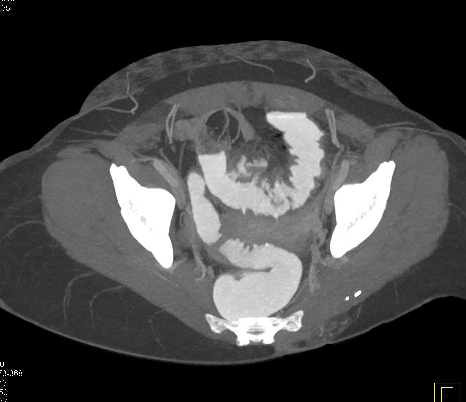 Diverticulitis With Abscess And Inflammation In Sigmoid Colon Colon