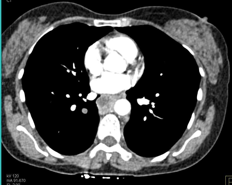 esophageal-cancer-with-widespread-metastases-esophagus-case-studies