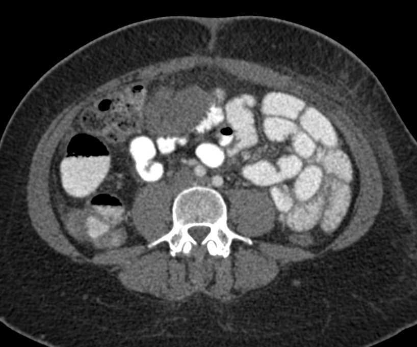 Mesenteric Cyst Gastrointestinal Case Studies Ctisus Ct Scanning