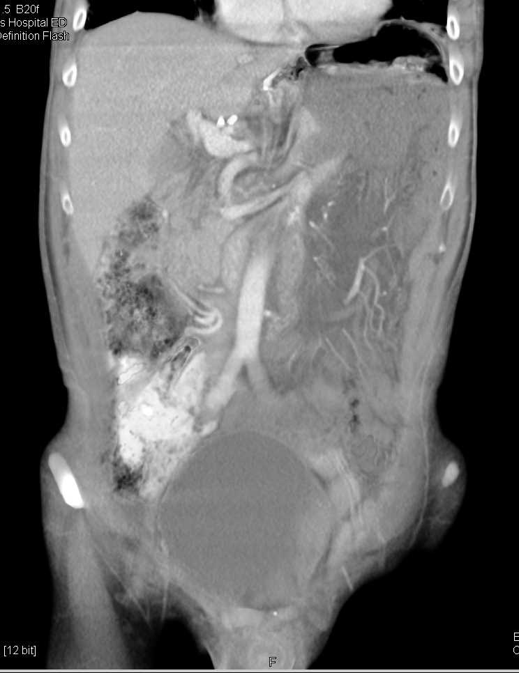 Internal Hernia within Left Upper Quadrant - Gastrointestinal Case
