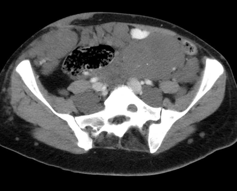 Neurofibromatosis with Extensive Masses in Abdomen and Para-Aortic