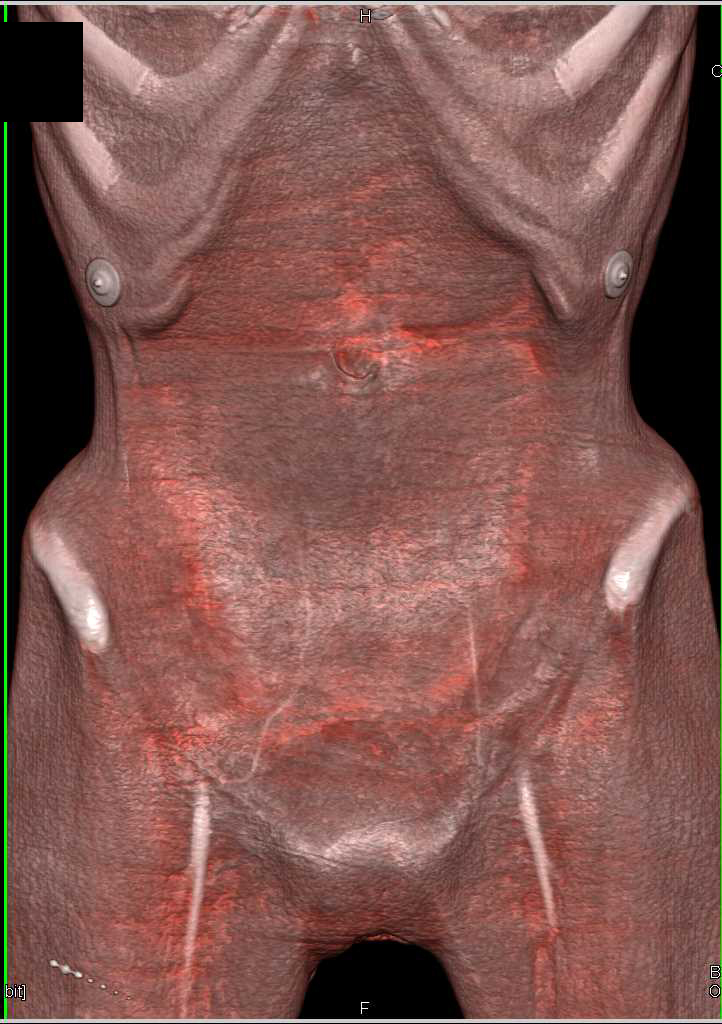 Scaphoid Abdomen and SMA Syndrome - Gastrointestinal Case Studies