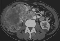 ctisus spread ct kidney studies case