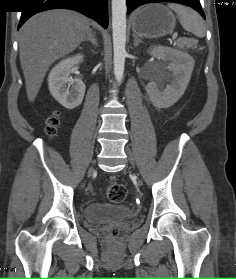 Stone in Distal Left Ureter Obstructs the Left Kidney - Kidney Case
