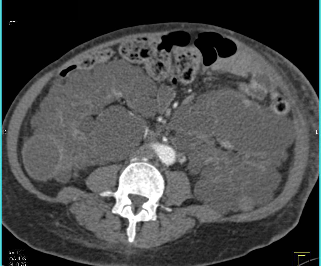 Polycystic Kidney Disease Kidney Case Studies Ctisus Ct Scanning