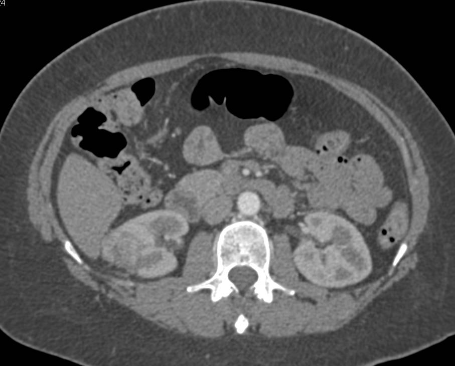 3cm Papillary Right Renal Cell Carcinoma - CTisus CT Scan