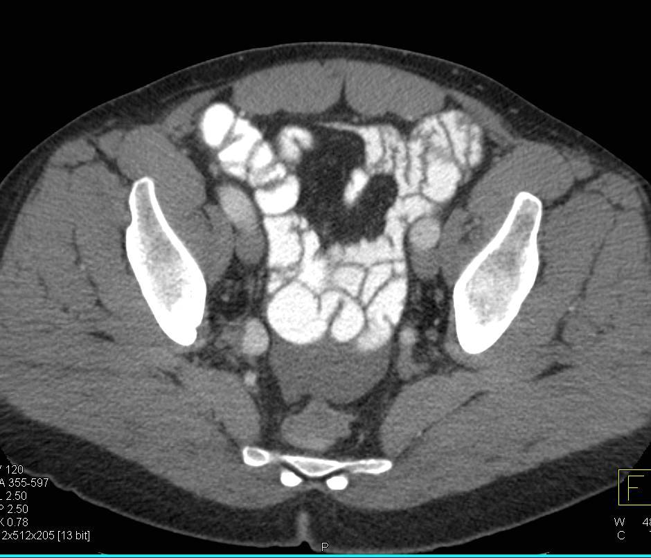 Impressive Intussusception of the Large Bowel due to a Lipoma - CTisus CT Scan