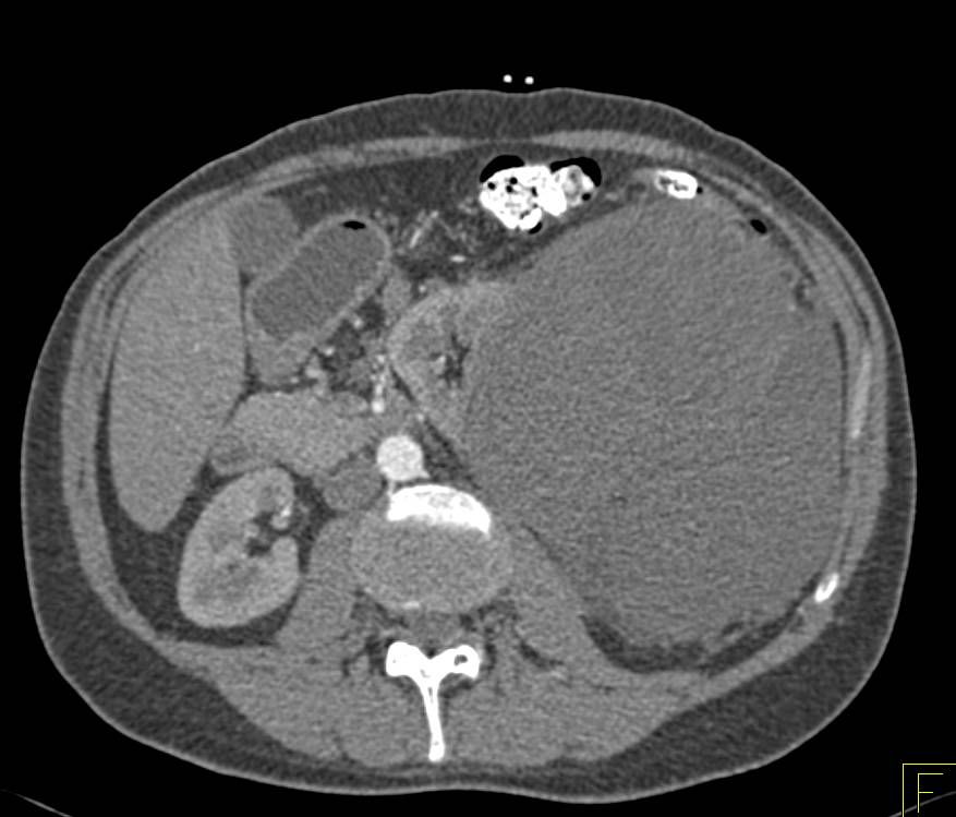 Retroperitoneal Sarcoma - Kidney Case Studies - CTisus CT Scanning
