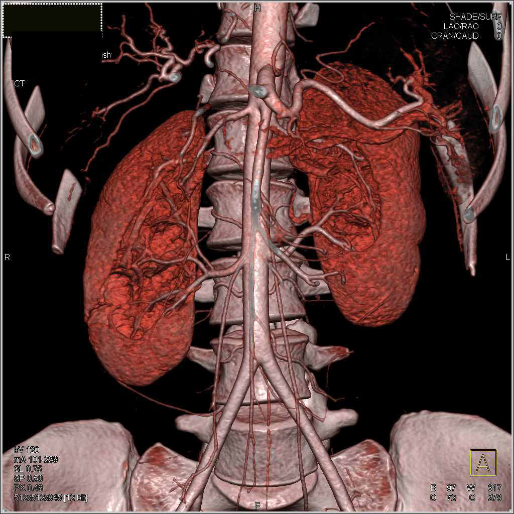 Dilated Right Renal Pelvis And Ureter Kidney Case Studies CTisus CT 