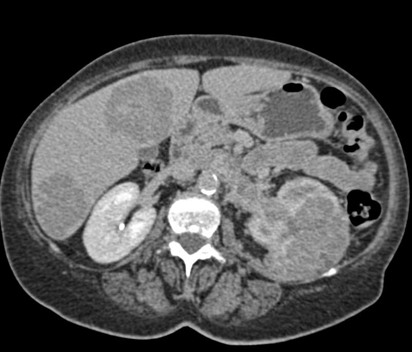 Renal Cell Carcinoma with Renal Vein and IVC Invasion with Liver