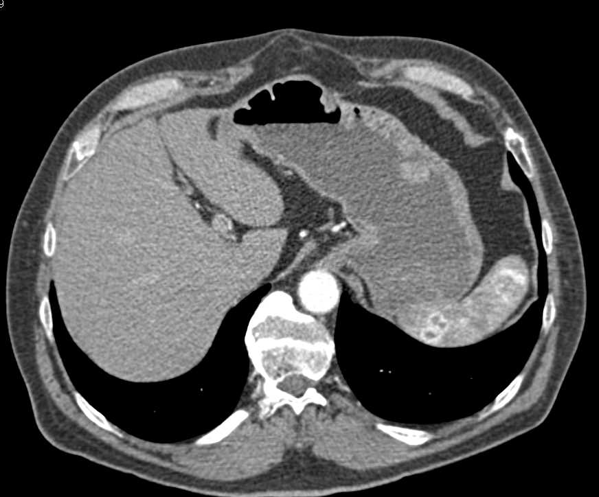Renal Cell Carcinoma Metastatic to the Stomach, Pleural Surface and Spleen - CTisus CT Scan