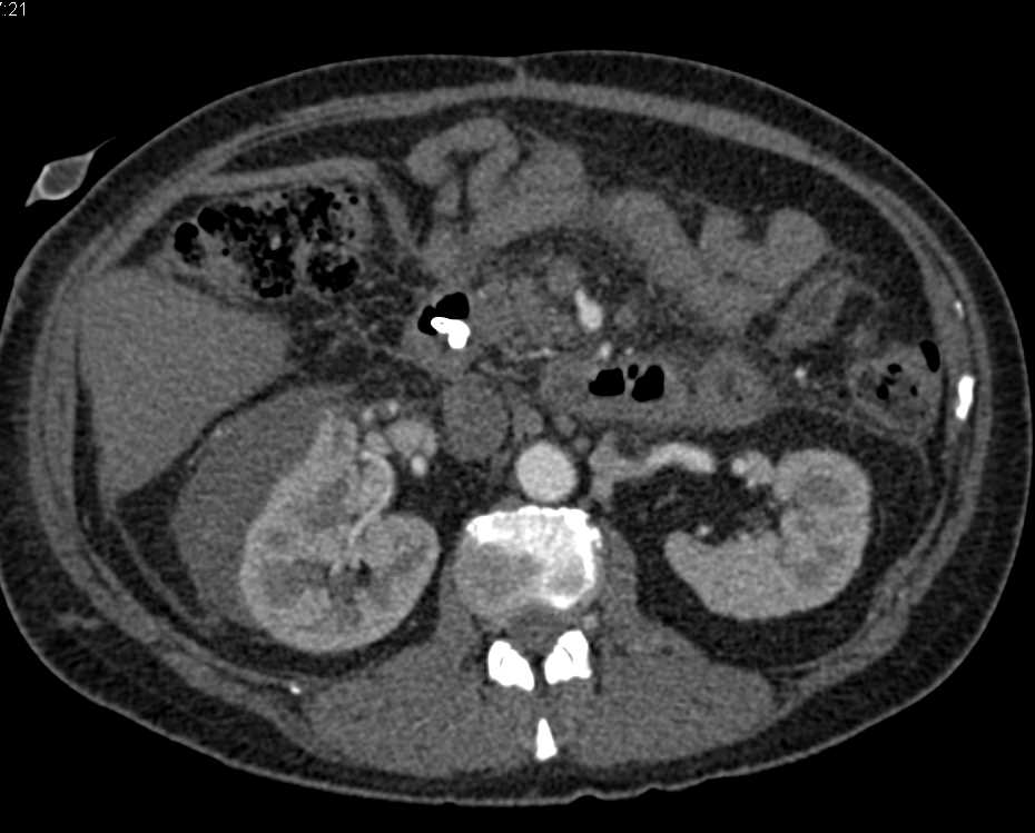 Perirenal Hematoma Right Kidney - Kidney Case Studies - CTisus CT Scanning