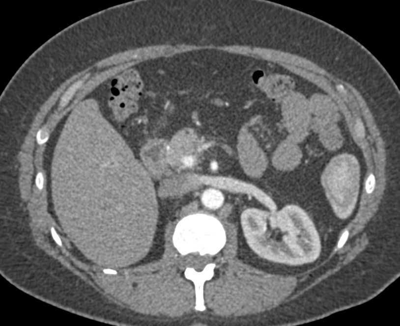 Metastatic Renal Cell Carcinoma to Pancreas and Liver - CTisus CT Scan