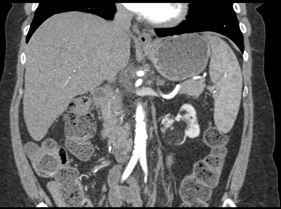 Left Renal Angiomyolipoma - CTisus CT Scan