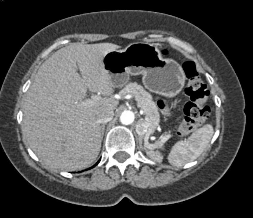 Recurrent Renal Cell Carcinoma with Adrenal Metastases - CTisus CT Scan