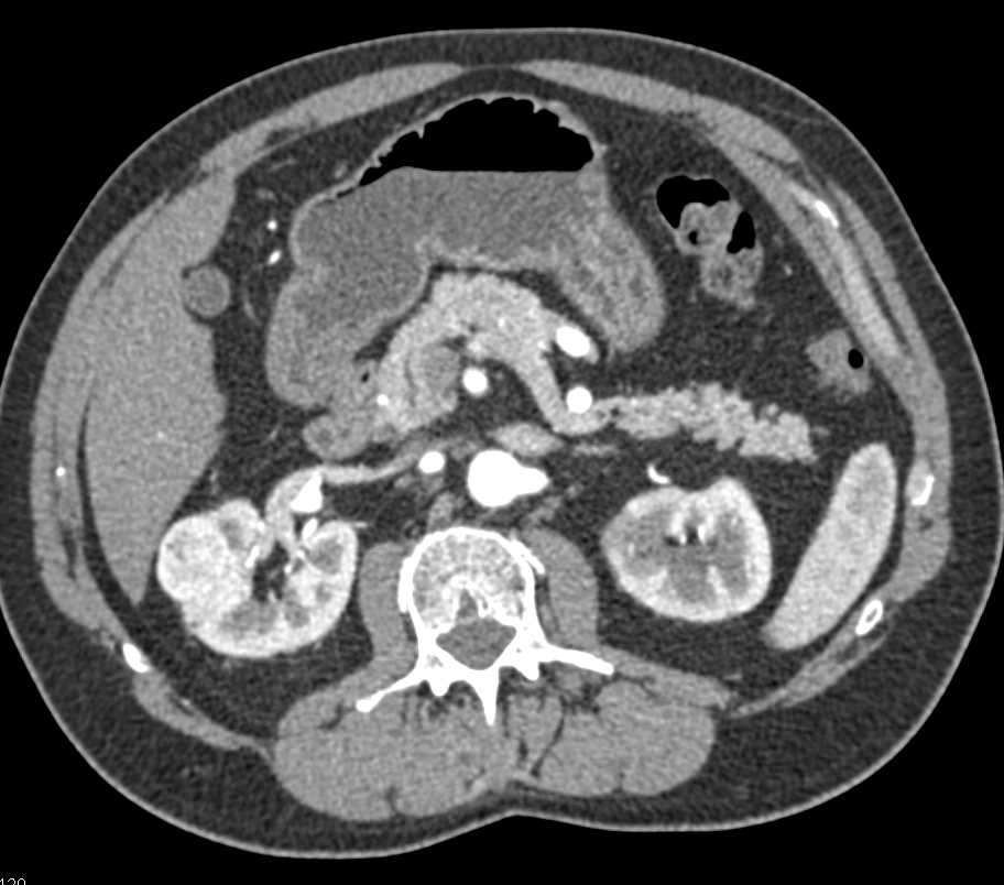 Incidental Clear Cell Renal Cell Carcinoma Right Kidney