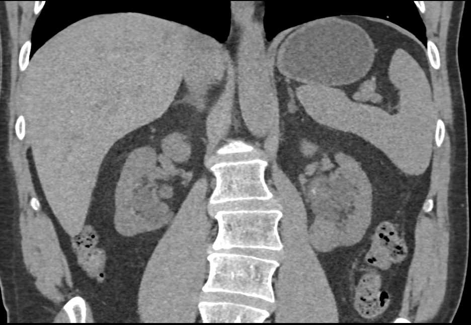 Parapelvic Cysts Left Kidney - Kidney Case Studies - CTisus CT Scanning