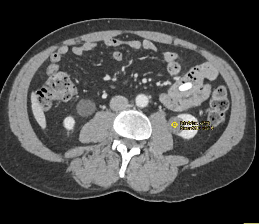 Parapelvic Cysts Left Kidney - Kidney Case Studies - CTisus CT Scanning