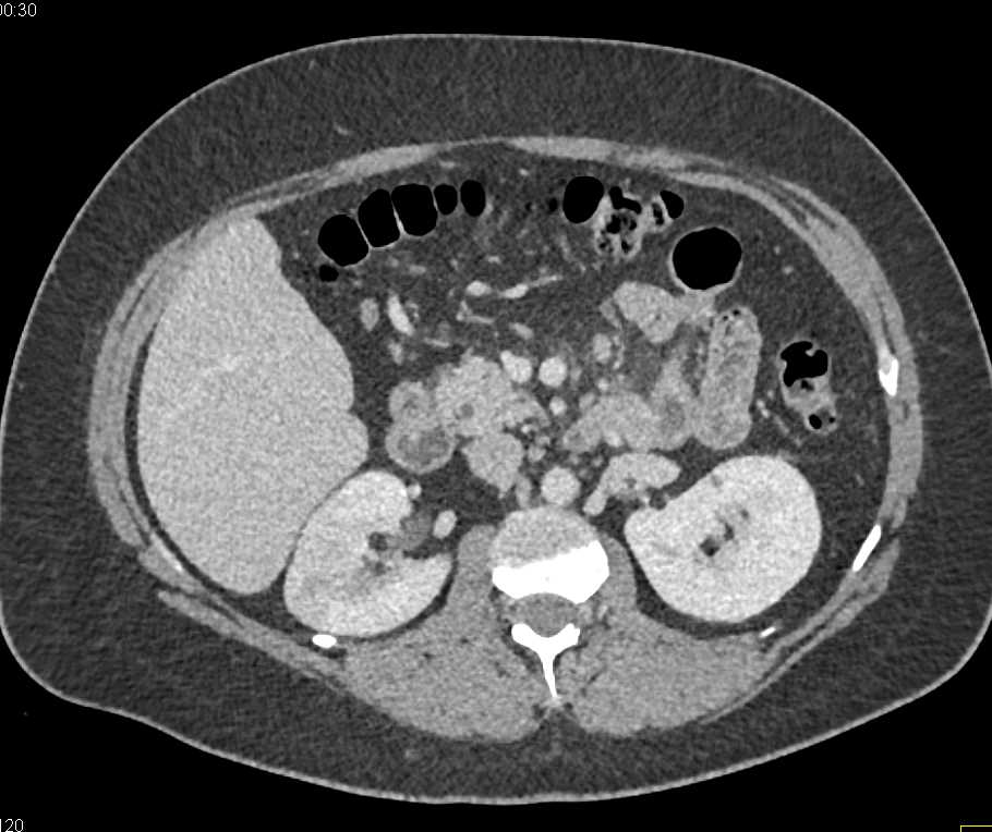 Acute Pyelonephritis Right Kidney Kidney Case Studies Ctisus Ct