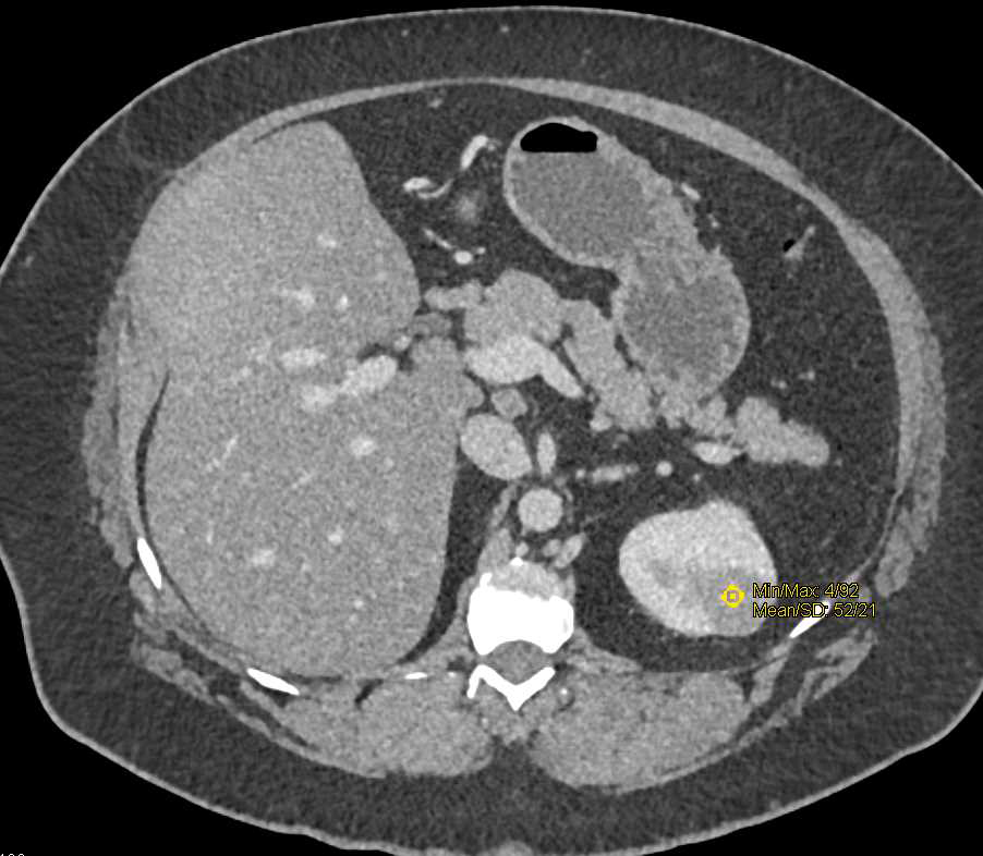 High Density Renal Cyst Left Kidney Kidney Case Studies CTisus CT