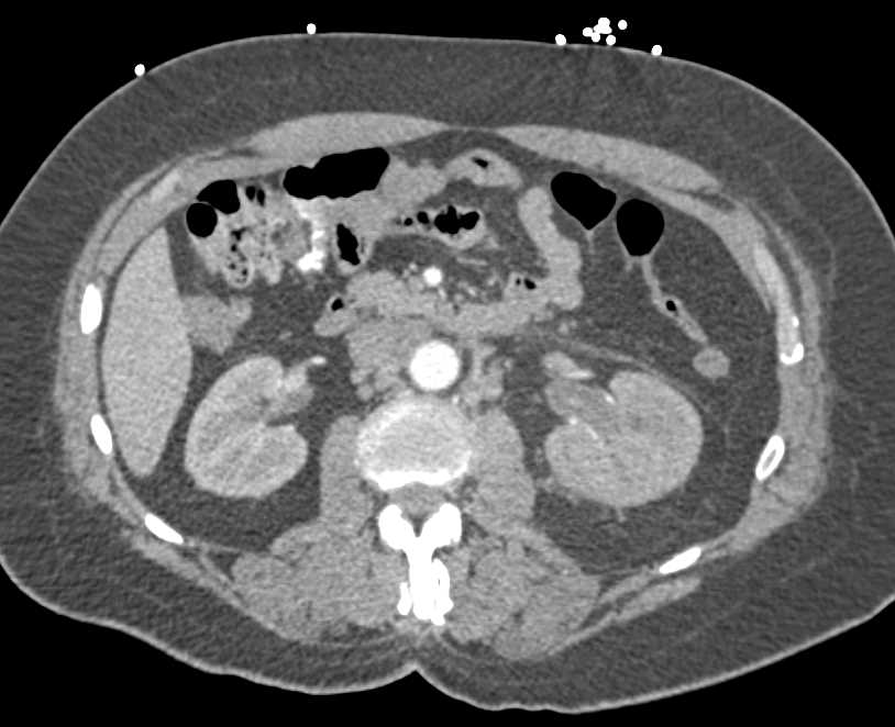 Transitional Cell Carcinoma Left Kidney with Bone Mets - CTisus CT Scan