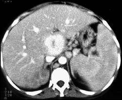 Peliosis Hepatis - Liver Case Studies - CTisus CT Scanning