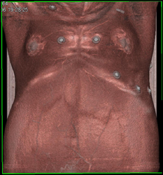 Cirrhosis With Ascites and Distended Abdomen With Varices and