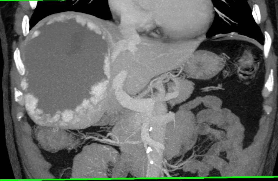 13 cm Giant Cavernous Hemangioma of the Liver - Liver Case Studies
