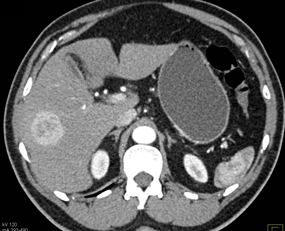 Focal Nodular Hyperplasia (FNH) - Liver Case Studies - CTisus CT Scanning